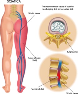 sciatica_diagram [Converted]