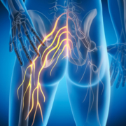 Osteopathy treatment for Sciatica